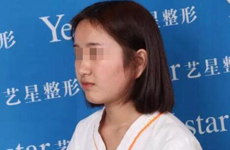 我想变美可未满18岁,可以割双眼皮么?