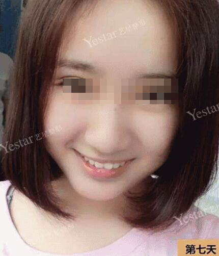 我想变美可未满18岁,可以割双眼皮么?