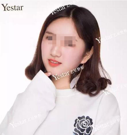 我想变美可未满18岁,可以割双眼皮么?