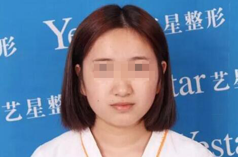 我想变美可未满18岁,可以割双眼皮么?