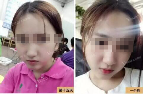 我想变美可未满18岁,可以割双眼皮么?