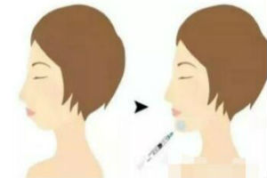 *丰下巴效果怎么样?我的变美经历分享~